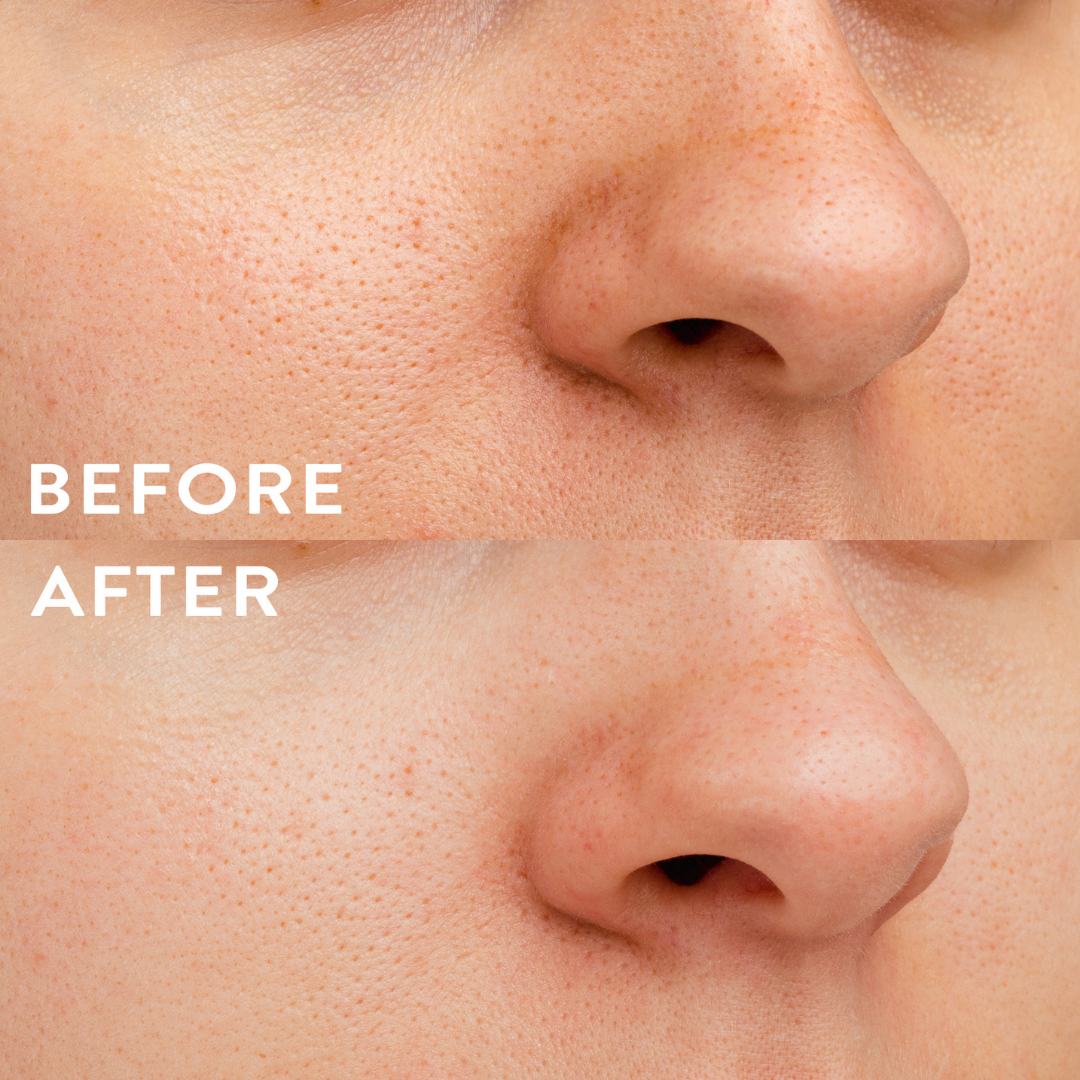 Before and after hydra patch on a womens face/nose