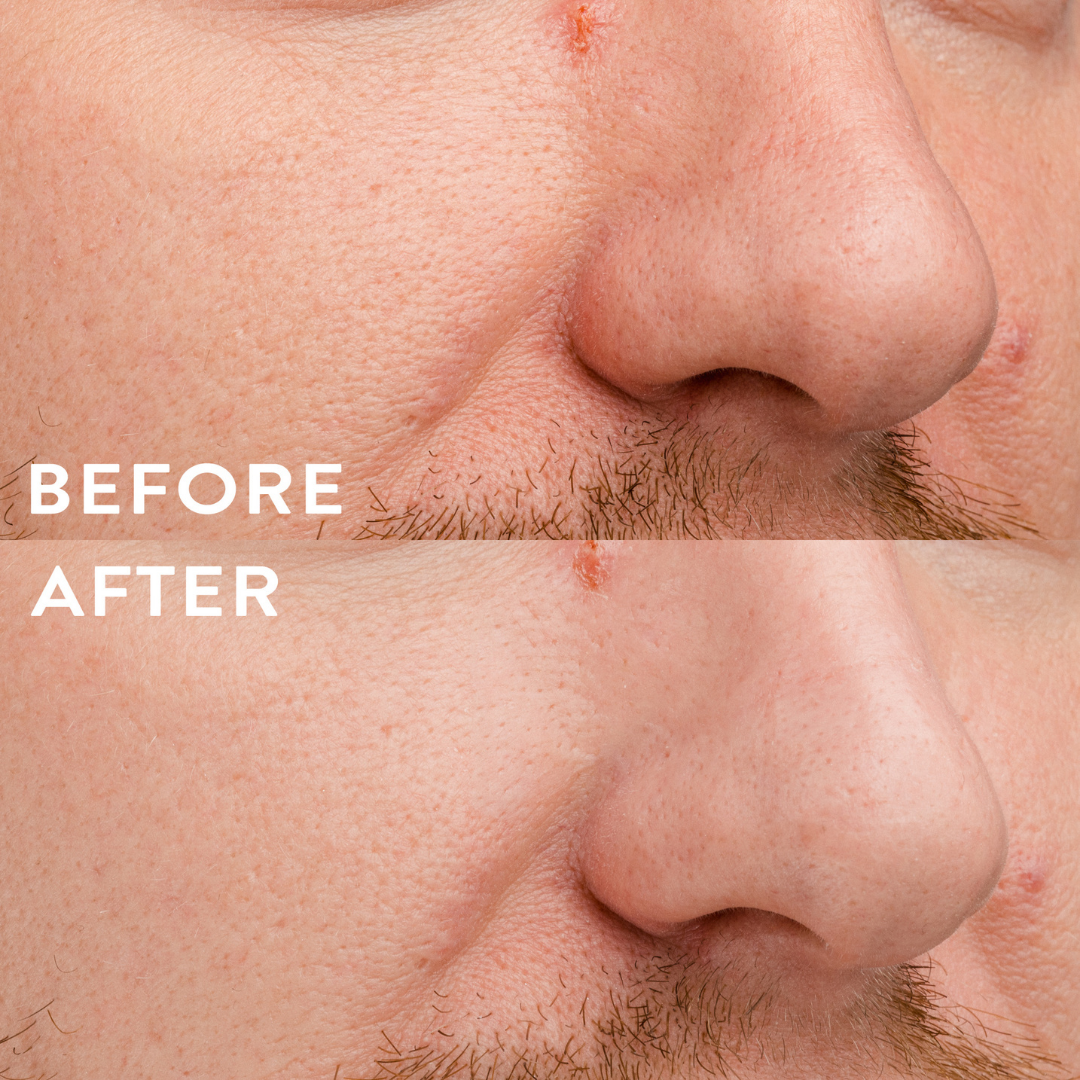 Before and after hydra patch men face