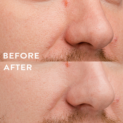 Before and after hydra patch men face